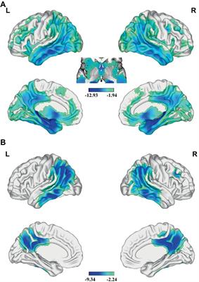 Association between gray matter atrophy, cerebral hypoperfusion, and cognitive impairment in Alzheimer’s disease
